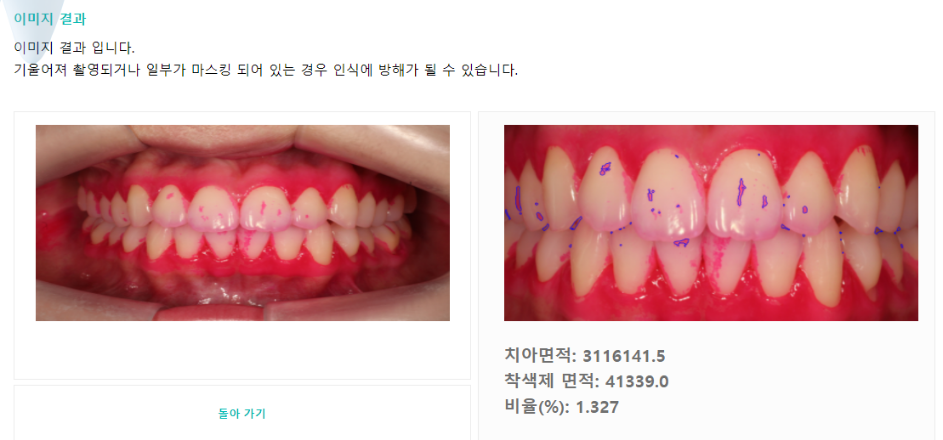 치아 착색제 디렉팅